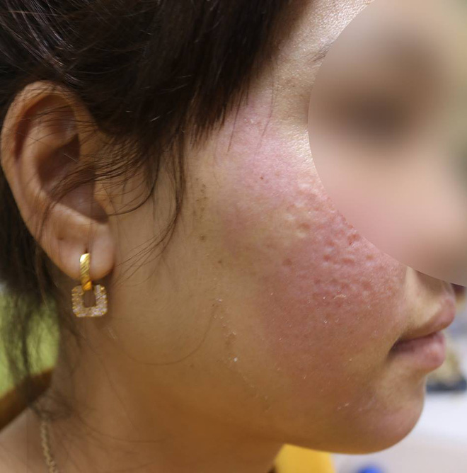 Hà Nội: Dùng kem trộn, một phụ nữ bị lột sạch da mặt, mất hàng trăm triệu điều trị nhưng chỉ phục hồi được 30-40% - Ảnh 3.